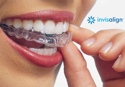 Invisalign